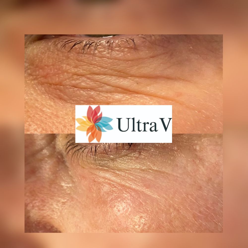 Linjerna under ögonen har minskat avsevärt efter behandling med Ultra V PDO.